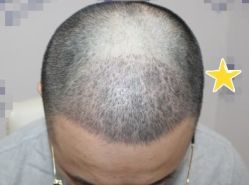 -大麦微针植发丨全国连锁