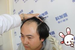 -大麦微针植发丨全国连锁