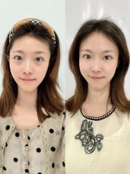 -广州健丽·去眼袋医疗美容机构