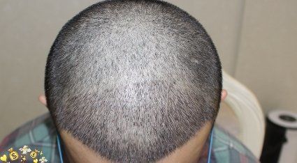 -大麦微针植发丨全国连锁