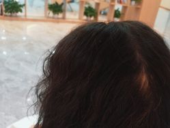 -碧莲盛·不剃发植发