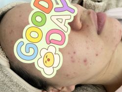 -苗方清颜痘肌研究所