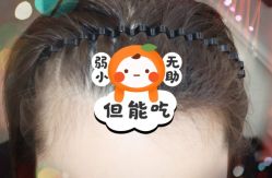 -大麦微针植发全国连锁