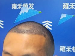 -雍禾植发全国连锁