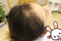 -大麦微针植发丨全国连锁