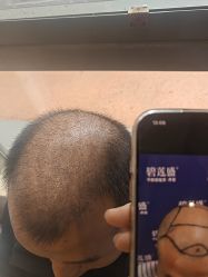 -碧莲盛·不剃发植发