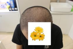 -大麦微针植发丨全国连锁