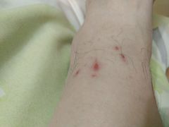 虫子咬的包-玉龙滑雪场