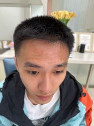 -大麦微针植发丨全国连锁
