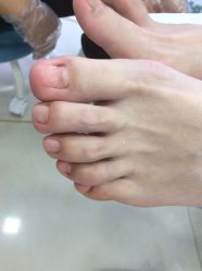 -德哥灰指甲脚气甲沟炎跖疣护理