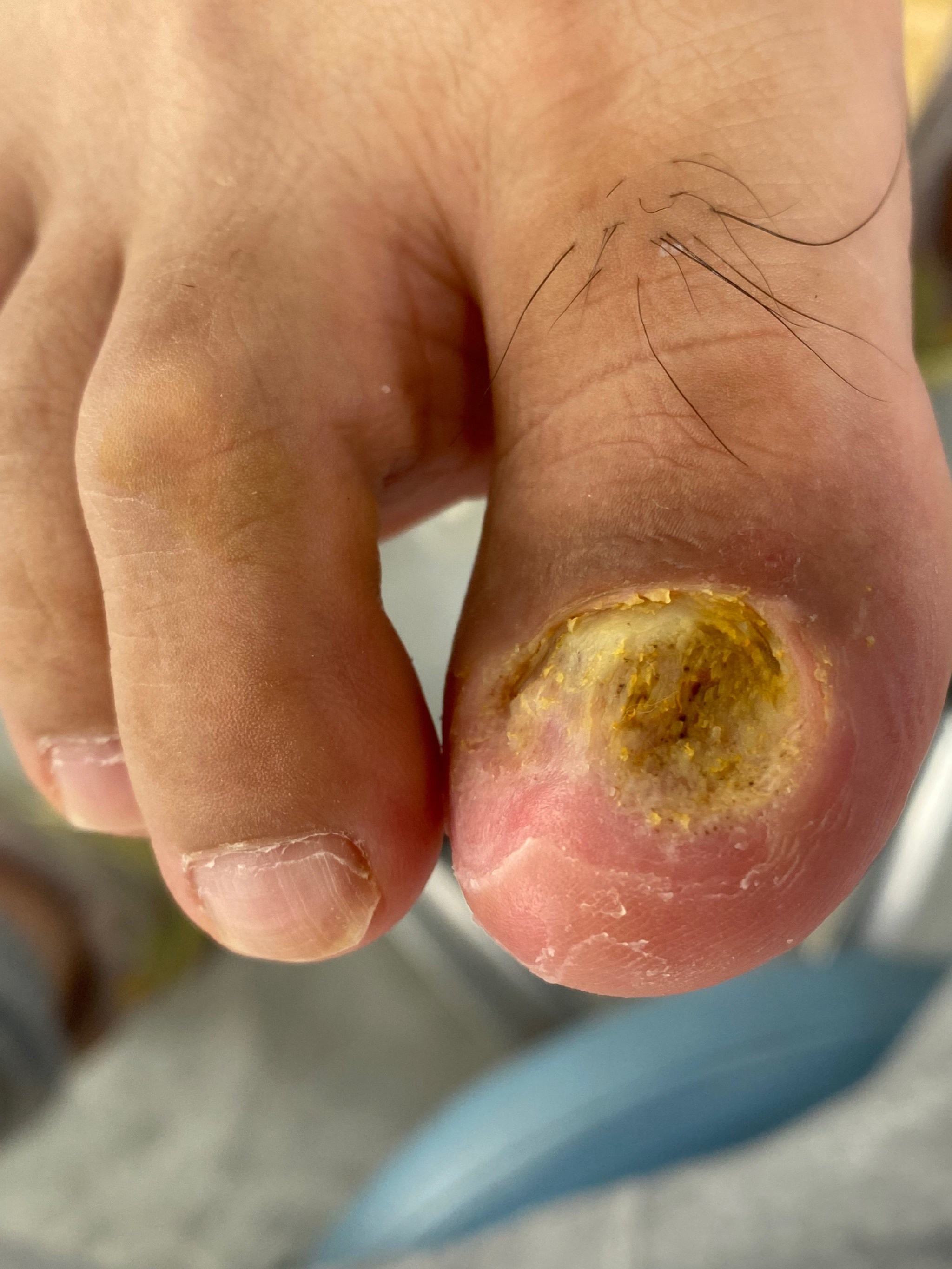 我的甲下病毒疣在甲舒乐用了两个多月搞好了非常开心感谢甲舒乐