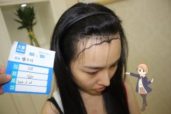 -大麦微针植发丨全国连锁