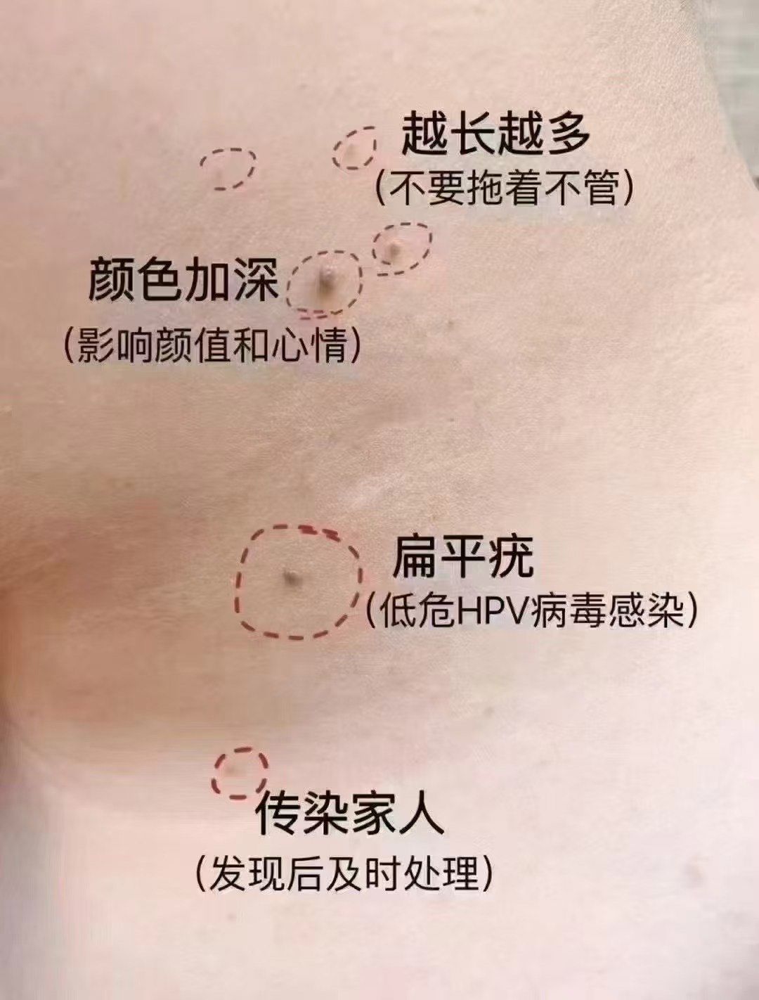 疣  传染吗✅
"一定会传染",尤其