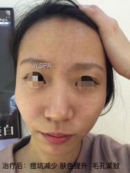 水光针-光SPA科技美肤