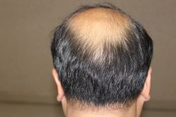 -大麦微针植发丨全国连锁