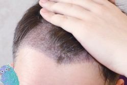 -大麦微针植发丨全国连锁