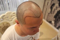 点击看大图 -大麦微针植发丨全国连锁