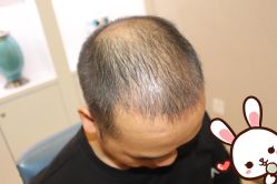 -大麦微针植发丨全国连锁