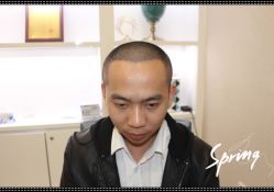 -大麦微针植发全国连锁