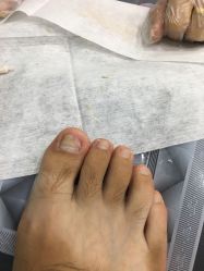 -德哥灰指甲脚气甲沟炎跖疣护理