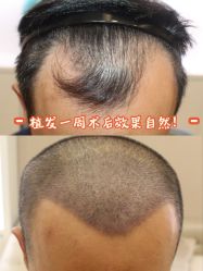 -大麦微针植发丨全国连锁