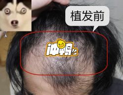 -大麦微针植发全国连锁