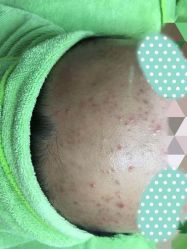 -苗医生草本科技祛痘