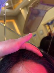 -碧莲盛·不剃发植发