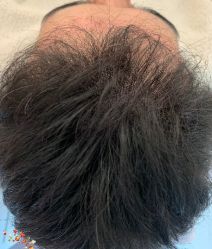 -大麦微针植发丨全国连锁