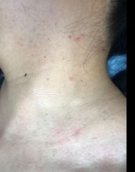 -爱莎扁平疣·汗管瘤·斑痣中心