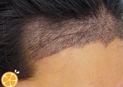 -大麦微针植发丨全国连锁