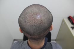 点击看大图 -大麦微针植发丨全国连锁