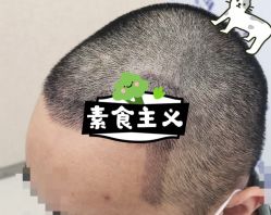 -大麦微针植发全国连锁