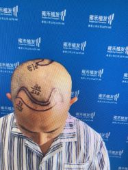 -雍禾植发全国连锁