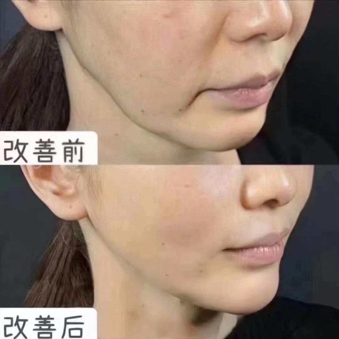 n面部分层精雕
重塑面部弹性纤维和胶原蛋白
使肌肤变得紧致勰 