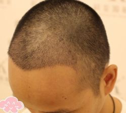 -大麦微针植发丨全国连锁