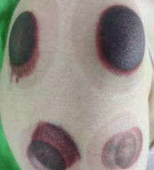 -苗塑堂减肥·艾灸