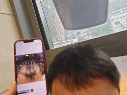 -碧莲盛·不剃发植发