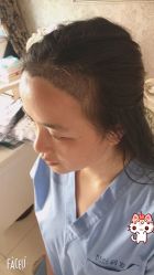 -大麦微针植发丨全国连锁