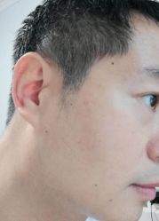 -爱莎扁平疣·汗管瘤·斑痣中心