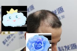 -大麦微针植发丨全国连锁