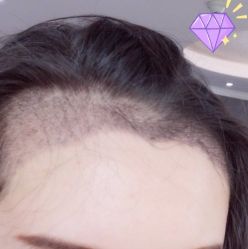 -大麦微针植发丨全国连锁