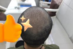 -大麦微针植发丨全国连锁