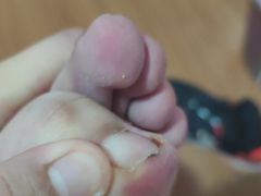 -祖传修脚甲沟炎灰指甲鸡眼