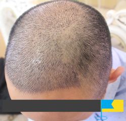 -大麦微针植发全国连锁