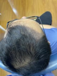 -大麦微针植发全国连锁