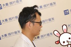 点击看大图 -大麦微针植发丨全国连锁