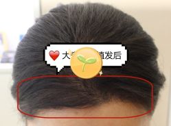 -大麦微针植发全国连锁