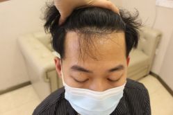 -大麦微针植发丨全国连锁