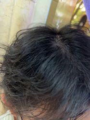 -碧莲盛·不剃发植发